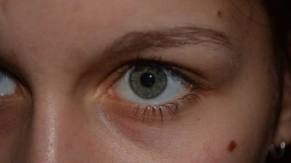 Cu&aacute;l es la funci&oacute;n de los lunares en el cuerpo